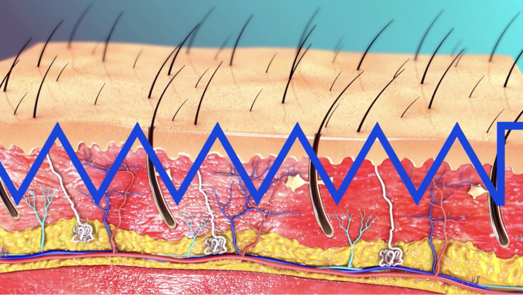 New Five-Day Transdermal Insulin Patch - Transdermal